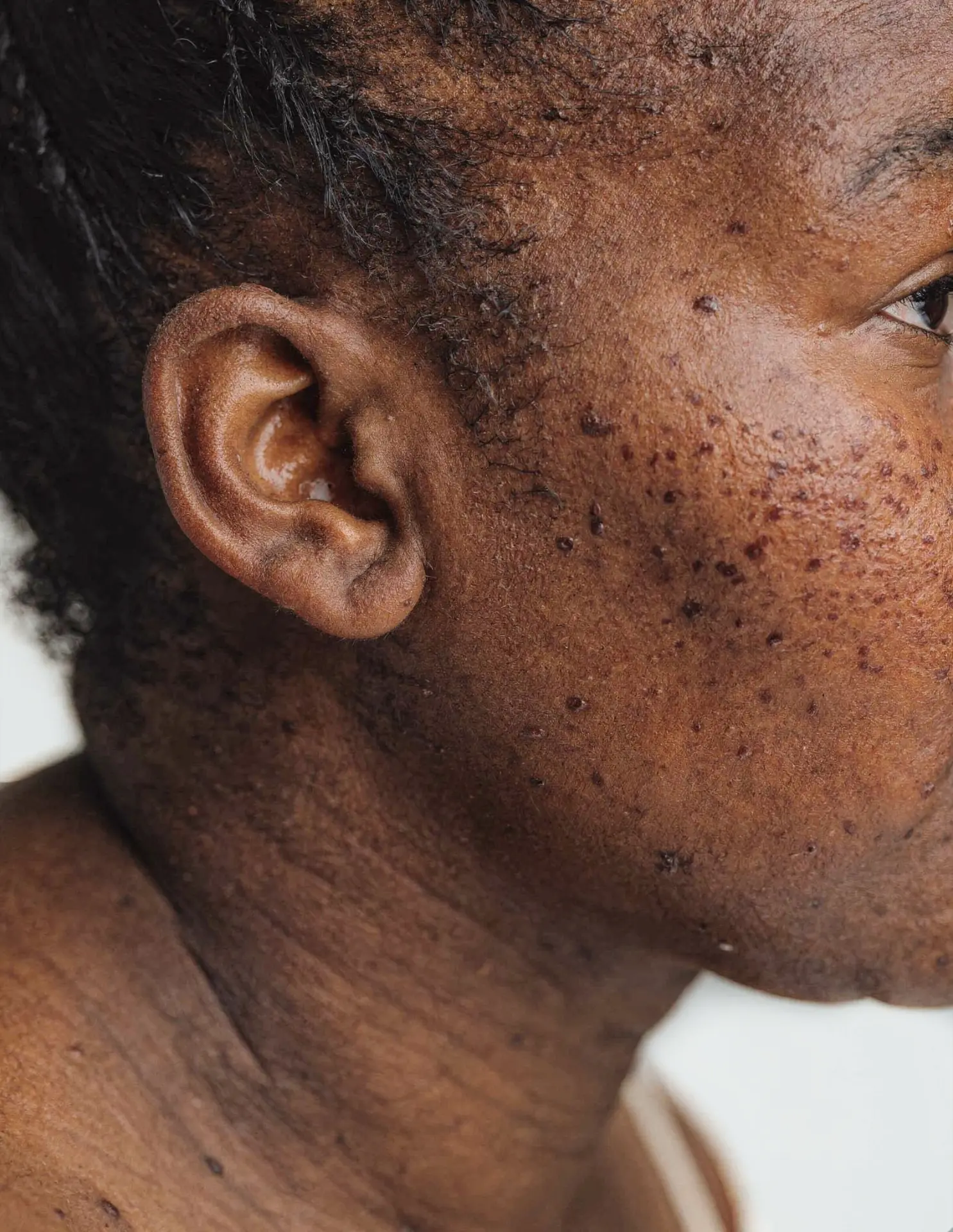 AI-generated close view of the same fictional woman's ear, cheek and neck, skin marked with freckles and raised moles